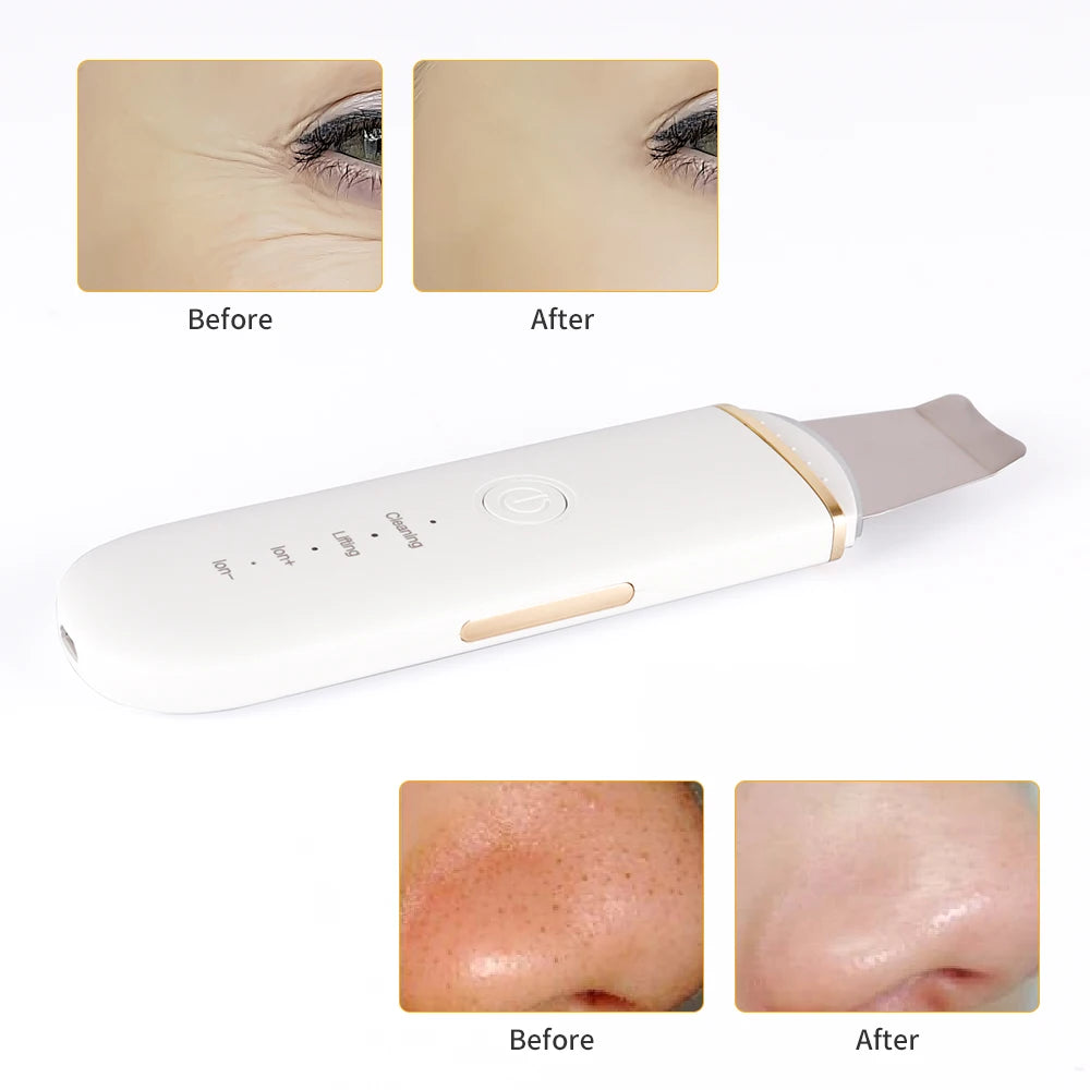 EMS Ultrasonic Skin Scrubber for face